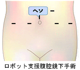 ロボット支援腹腔鏡下手術