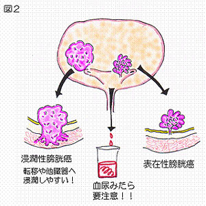 膀胱癌の2つのタイプ