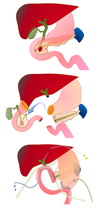 図7 膵体尾部切除術