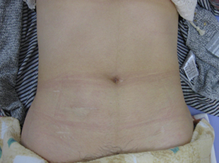 潰瘍性大腸炎術後17年（開腹手術）