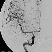 図8 脳血管撮影（脳動静脈奇形術後）
