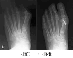 足関節外側靭帯損傷