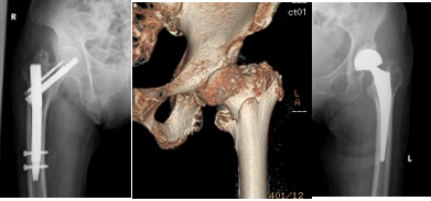 股関節を骨折してしまった患者さんのより良い社会復帰のために