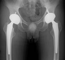 人工股関節置換術、人工膝関節置換術