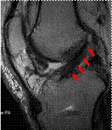 腱を移植するために長方形に作成した骨孔