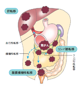 図4　胃がんの進行の説明図