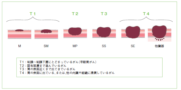 図5　壁深達度分類（日本胃癌学会編：胃癌取り扱い規約. 第14版. 金原出版. 2010.より改変）