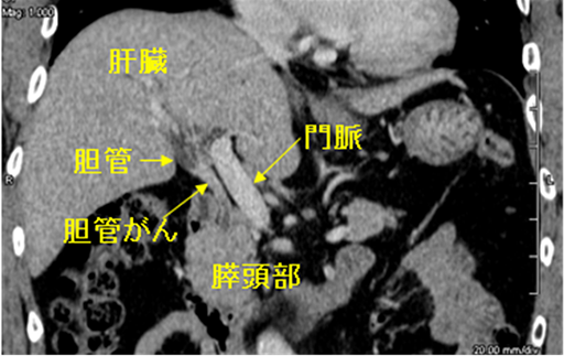 図2B CT検査 縦切りの写真