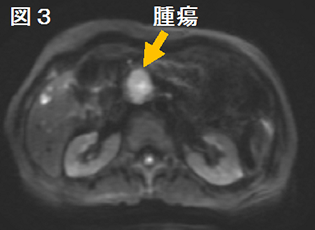 図3 MRI拡散強調画像