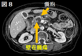 図8 膵管内乳頭粘液性腫瘍
