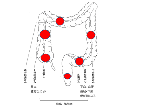 女性 痛み 左下 腹部