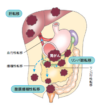 腹膜 播種