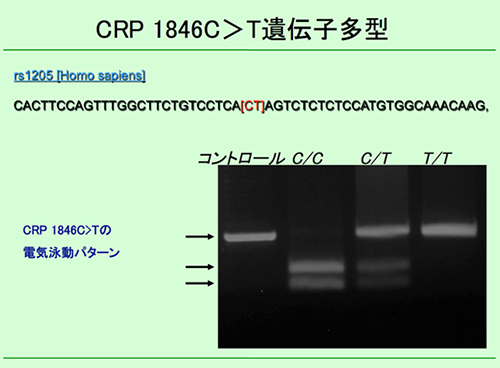 CRP 1846C > T遺伝子多型