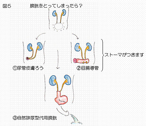 膀胱摘出手術と尿路変更術