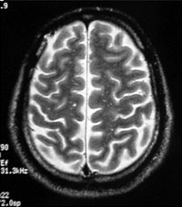 照射24ヶ後 照射24ヵ月後