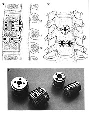 頚椎症、頚椎椎間板ヘルニアに対する頚椎前方固定術