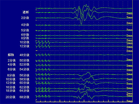 バイパス手術時における、一時脳血流遮断時の術中MEP