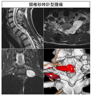 腫瘍性疾患