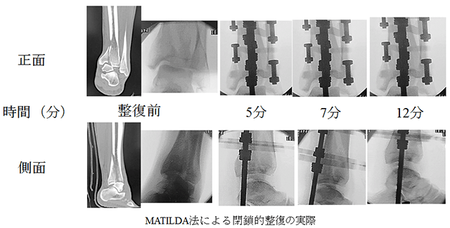 軟部組織損傷を伴う高齢者Pilon骨折に対するMATILDA法