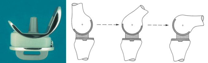 単顆置換型人工膝関節