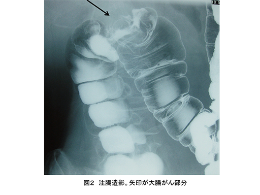 注腸造影。矢印が大腸がん部分