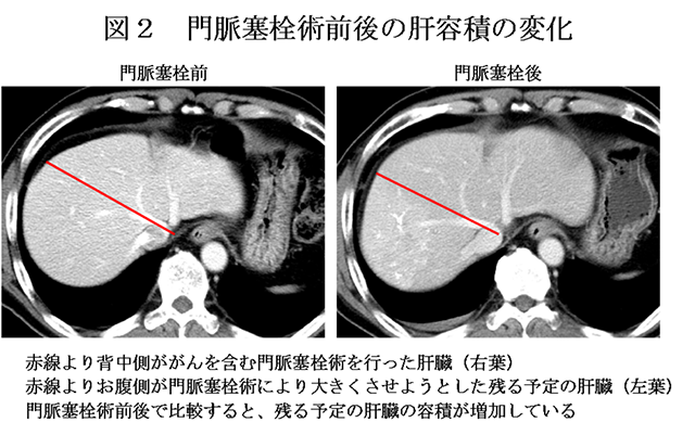 図2　門脈枝塞栓術前後の肝容積の変化