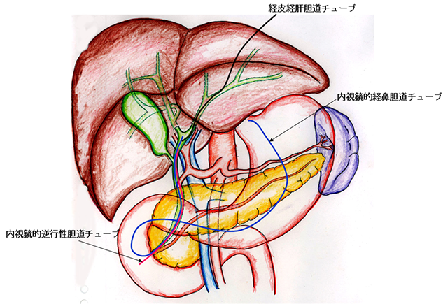 図3 減黄処置 チューブ留置法