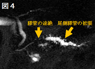 図4 MRCP画像