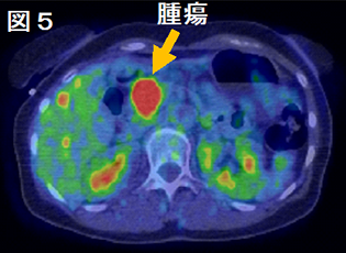 図5 FDG-PET検査