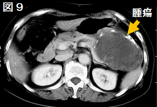 図9 粘液性嚢胞性腫瘍