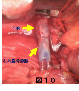 図10 自家移植