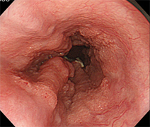 食道癌の上部消化管内視鏡像