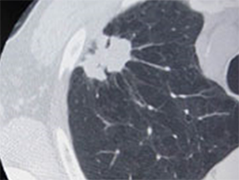 肺癌のセンチネルリンパ節の研究
