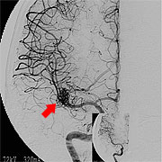 図7 脳血管撮影（脳動静脈奇形術前）