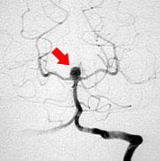 図3 脳血管撮影脳底動脈先端部動脈瘤