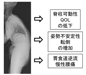 骨粗鬆症による脊柱変形