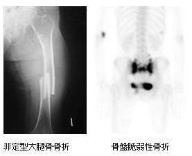 非定型大腿骨骨折