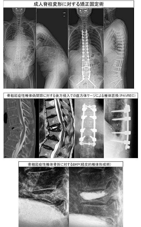骨粗鬆症や脊椎変性疾患、成人脊柱変形