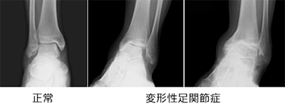 変形性足関節症