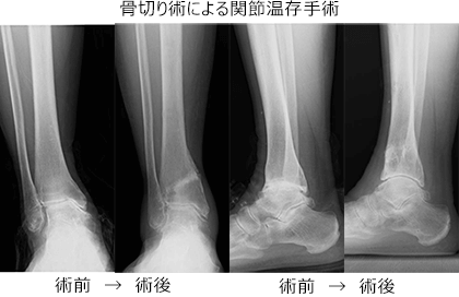 変形性足関節症