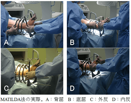 軟部組織損傷を伴う高齢者Pilon骨折に対するMATILDA法