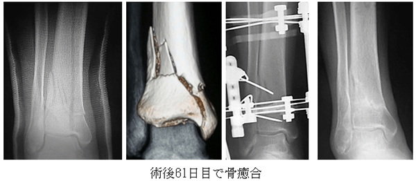 骨粗鬆症性＋粉砕骨折に対するIlizarov創外固定＋CELTAB法