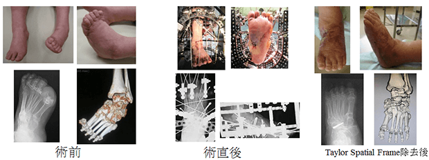Ilizarov創外固定による足部変形矯正