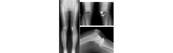 単顆置換型人工膝関節