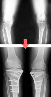 人工股関節置換術、人工膝関節置換術